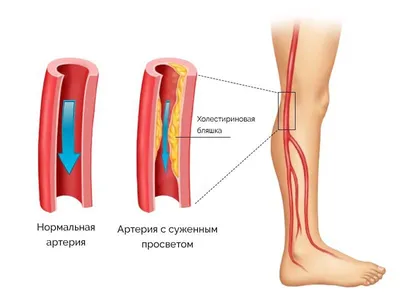 Облитерирующий эндартериит (ноги курильщика) - симптомы, лечение