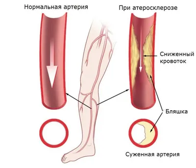 Эндартериит облитерирующий (ЭО) - причины и признаки эндартериита  облитерирующего (ЭО)