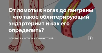 Облитерирующий эндартериит: симптомы и лечение