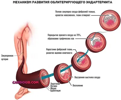 Облитерирующий эндартериит - презентация онлайн