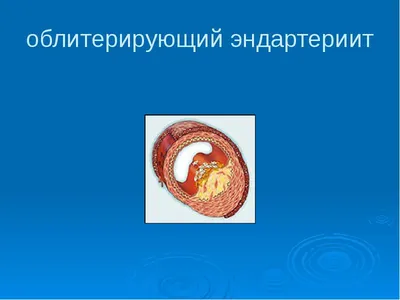 Лечение диабетической стопы on Instagram: \"👣Критическая ишемия нижних  конечностей - особая форма состояния кровообращения, при котором отмечается  высокий риск развития необратимых изменений ноги и угроза ампутации.  Недостаточность артериального ...