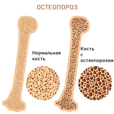 Остеопороз - причины появления, симптомы заболевания, диагностика и способы  лечения