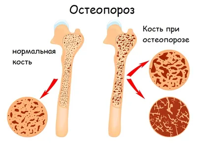 Остеопороз: что это, симптомы, лечение, причины появления и советы