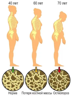 Остеопороз костей - симптомы и причины, профилактика заболевания.