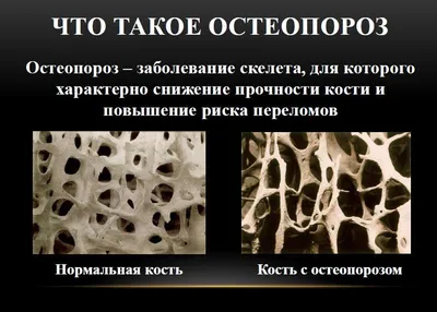 Детский и подростковый остеопороз: причины и актуальные методы лечения -  ОБУЗ «ДГКБ № 5» г. Иваново