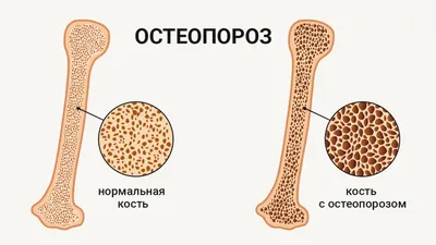 С 16 по 22 октября 2023 года проводится неделя профилактики остеопороза (в  честь Всемирного дня борьбы с остеопорозом 20 октября). | ГБУ РО