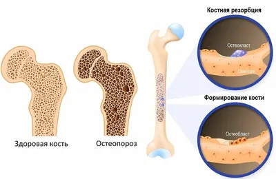 Остеопороз – причины и факторы риска, симптомы, диагностика, лечение,  профилактика