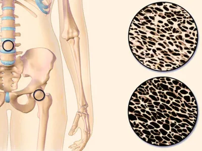 Tiklanish.uz - Что такое остеопороз? Наше тело регулярно заменяет  компоненты наших костей. Когда эти компоненты теряются слишком быстро или  недостаточно пополняются (или оба) возникает остеопороз. В то время как  женщины подвергаются более