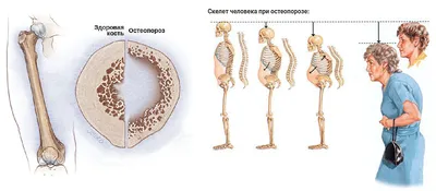 Менопаузальный остеопороз - диагностика, причины, лечение в многопрофильной  клинике UNICLINICA