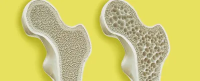 Что такое остеопороз и как его предотвратить? | Блог | Complimed