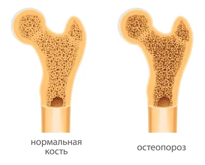 Остеопороз - Центр доктора Бубновского в Краснодаре