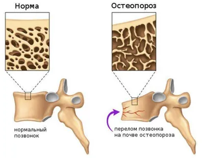 Что такое остеопороз? - статья по теме Эндокринология - МЦОЗ