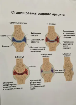 Лечение остеопороза в Екатеринбурге - Новая Больница