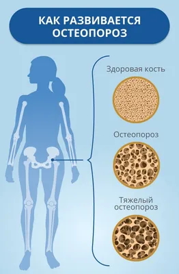 Остеопороз: причины, симптомы, лечение