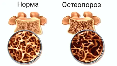 Остеопороз у женщин после 50 - лечение в Ростове-на-Дону