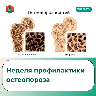 Лечение остеопороза в санатории в Татарстане