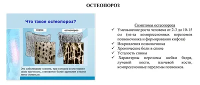 Лечение остеопороза в Одессе - оздоровительный центр Евминов–Кудряшова