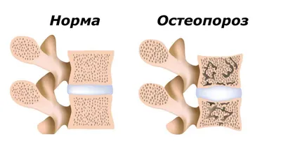 16-22 октября неделя профилактики остеопороза в честь Всемирного дня борьбы  с остеопорозом. — ГБУЗ \"Унечская ЦРБ\"