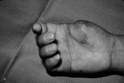 Что делать, если сломал палец на ноге? - полезные статьи от специалистов -  Медицинский центр «АудиоМед»