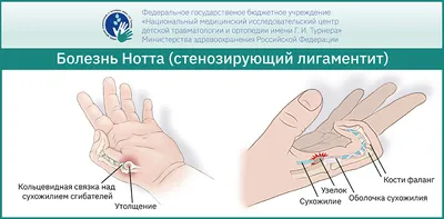 Болит большой палец на руке - Первая Медицинская Клиника