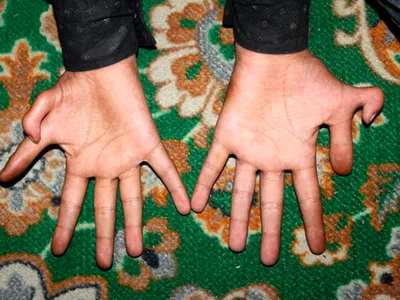 Гипс руки особенно большой палец Стоковое Изображение - изображение  насчитывающей сломленные, реально: 171959097