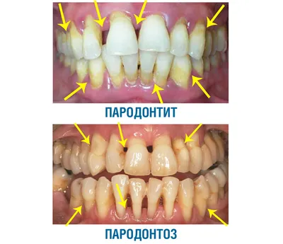Лечение десен в стоматологии пародонтоз пародонтит и гингивит