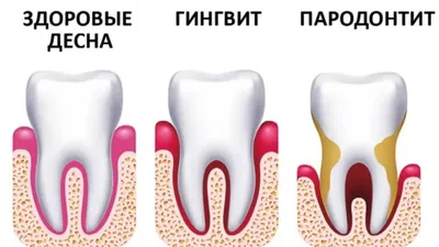 Лечение пародонтоза и пародонтита в Краснодаре по низкой цене |  Стоматология «Для Семьи»