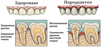 Лечение пародонтоза у детей - основные причины возникновения и способы  профилактики