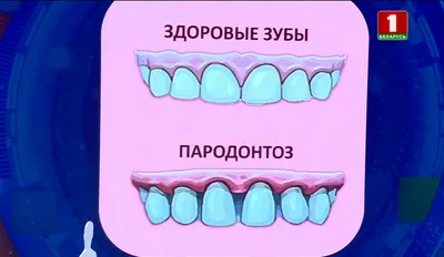 Пародонтоз виды и симптомы, лечение пародонтоза в Москве