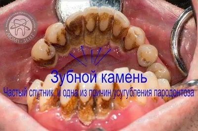 Лечение десен зубов, воспаления, пародонтоза, гингивита, пародонтита в Китае