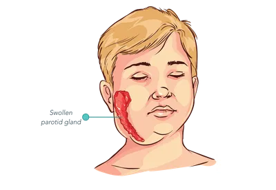Вакцина ММR II: корь, краснуха, паротит | Клиника Фэнтези