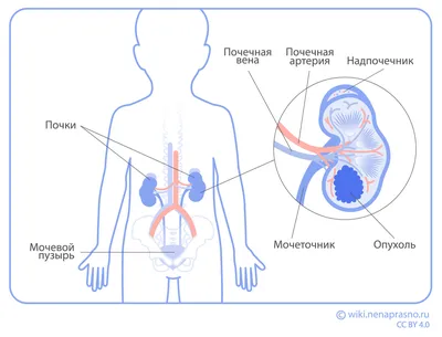 Рак почки — клиника «Добробут»