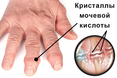 Лечение подагры на руках в Москве | Клиника “Здравствуй”