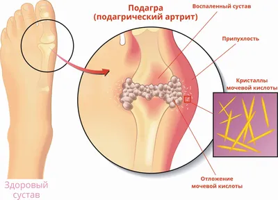 Лечение ревматоидного артрита в Омске | цены на услуги врача в клинике  Центр EzraMed Clinic