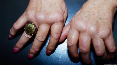 Соединение пальца большого пальца руки получает неожиданная, интенсивная  боль в ноче как подагра Стоковое Изображение - изображение насчитывающей  здоровье, условие: 71803273