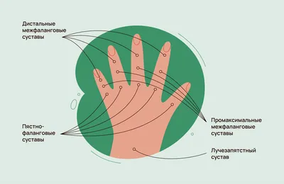 Артрит пальцев рук: причины, симптомы и лечение
