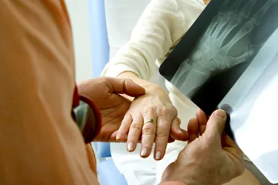 Множественный совместный артрит обе руки (подагра, ревматоидные) на черной  предпосылке Стоковое Фото - изображение насчитывающей пациент, воспаление:  48512554