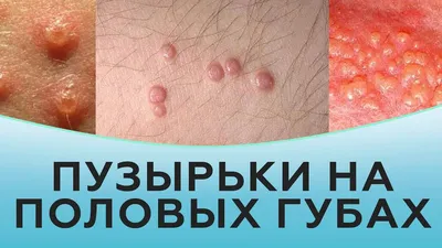 Коррекция формы малых половых губ - Лабиопластика в Санкт-Петербурге