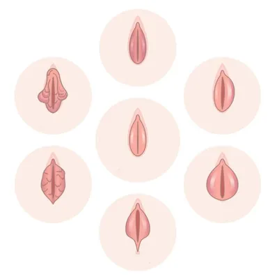 Лабиопластика. Пластика малых и больших половых губ