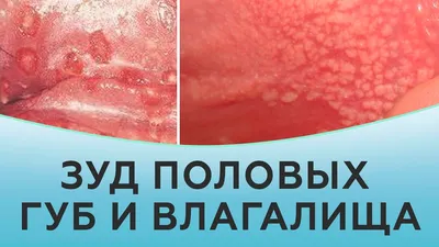Интимная биоревитализация половых губ в СПб - Цены, отзывы