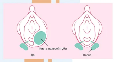 Лабиопластика - Цена операции, сделать пластику половых губ в Минске