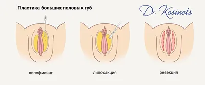 Киста половой губы: причины, симптомы, диагностика, лечение, операция в  клинике «АльтраВита»