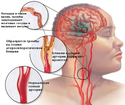 Профилактика инсульта и инфаркта ГБУЗ ВФД г.Копейск