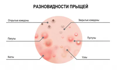 Акне (прыщи) у взрослых. Причины и способы борьбы.