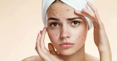 Прыщи на щеках у женщин: причины появления, как избавиться от акне и угрей,  лечение в косметологической клинике