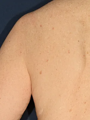 Плоскоклеточный рак кожи – симптомы, фото, лечение и диагностика