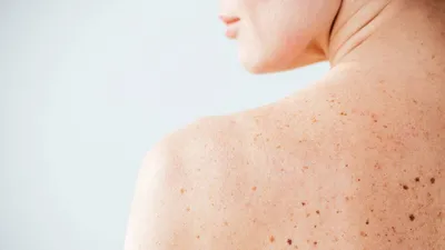 Ранний базальноклеточный рак кожи.