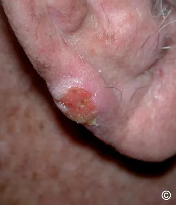 Клинические наблюдения лечения базально-клеточного рака кожи ушной раковины.