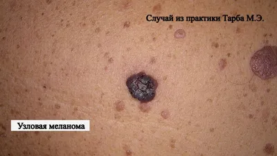 Рак кожи в людях стоковое фото. изображение насчитывающей вакханические -  115717984