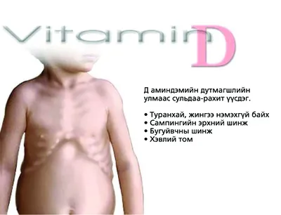 Рахит детей раннего возраста на фоне дефицита витамина Д кальция и фосфатов  - YouTube